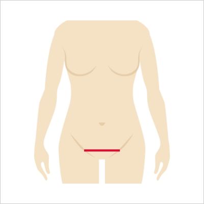 개복수술절개