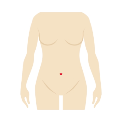 다빈치 단일공 로봇수술